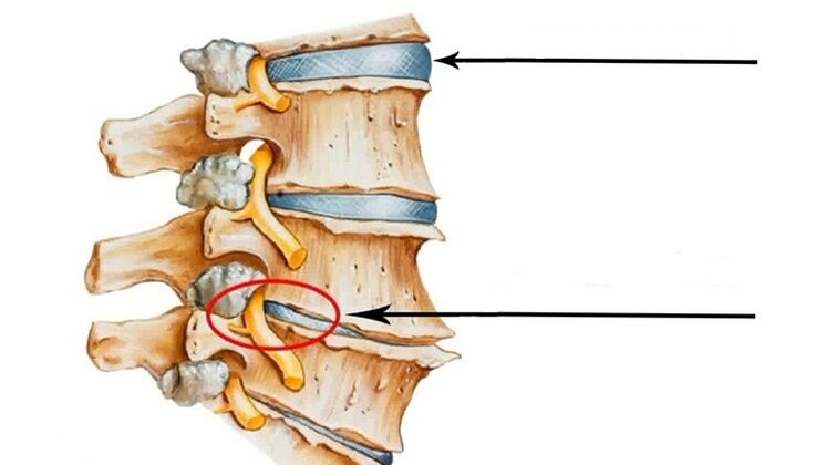 ग्रीवा osteochondrosis के मामले में रीढ़ की हड्डी में चोट