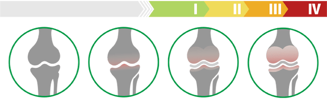 घुटने के जोड़ के आर्थ्रोसिस के नैदानिक ​​चरण (घुटने के जोड़ के आर्थ्रोसिस की डिग्री)