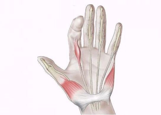 उंगलियों के जोड़ों में दर्द के कारण कण्डरा की सूजन