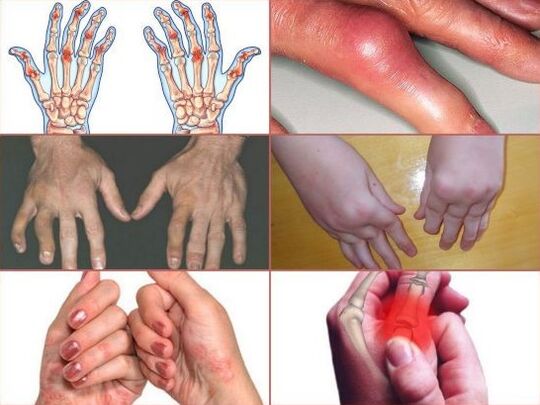 उंगलियों के जोड़ों में दर्द